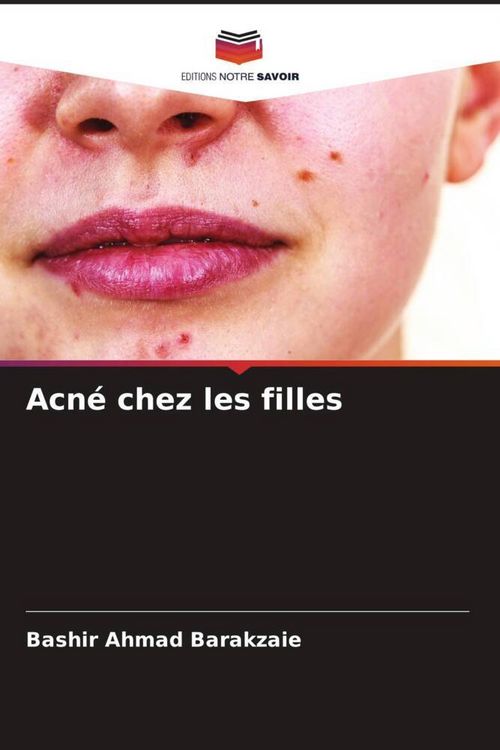 Produktbild: Acn&eacute; chez les filles