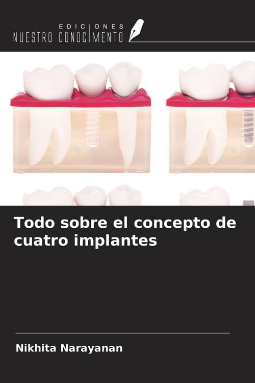 Produktbild: Todo sobre el concepto de cuatro implantes