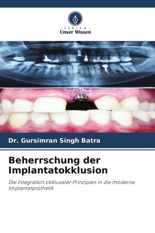 Produktbild: Beherrschung der Implantatokklusion