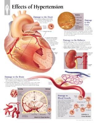 Produktbild: Effects Of Hypertension Chart