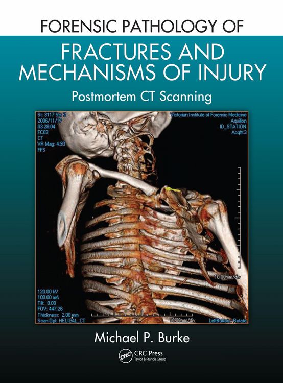 Produktbild: Forensic Pathology of Fractures and Mechanisms of Injury