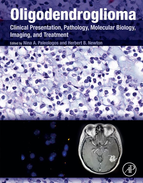 Produktbild: Oligodendroglioma