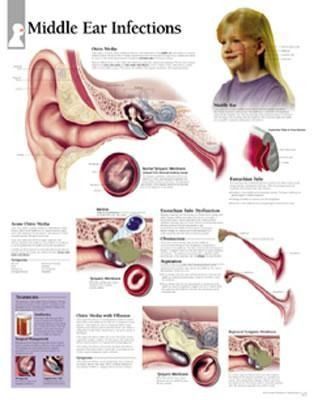 Produktbild: Scientific Publishing: Middle Ear Infections Paper Poster