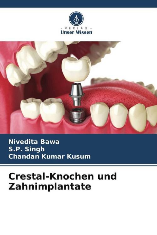 Produktbild: Crestal-Knochen und Zahnimplantate