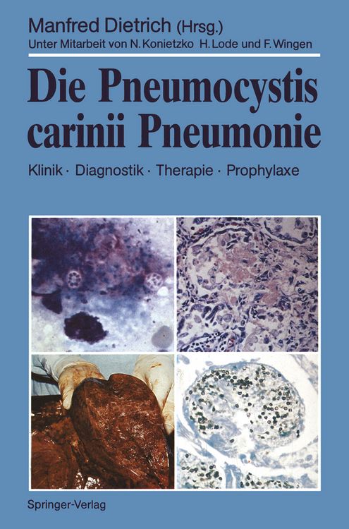 Produktbild: Die Pneumocystis carinii Pneumonie