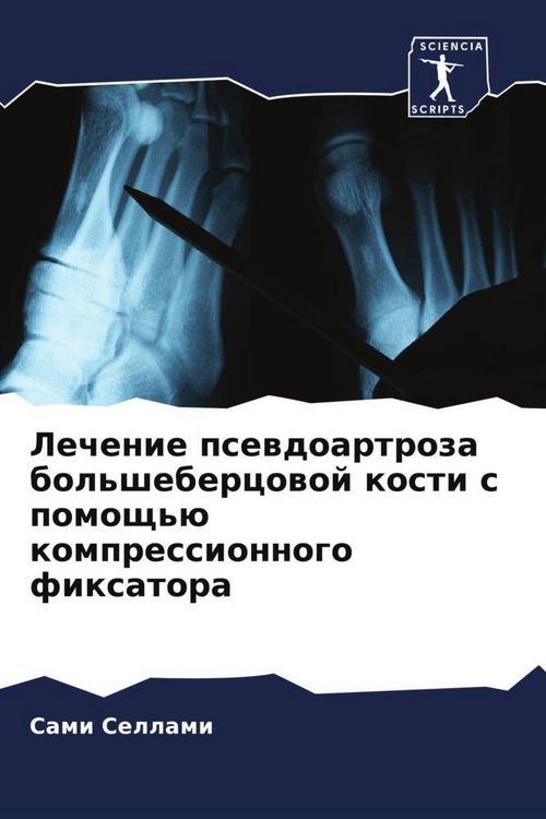 Produktbild: Lechenie psewdoartroza bol'shebercowoj kosti s pomosch'&uuml; kompressionnogo fixatora