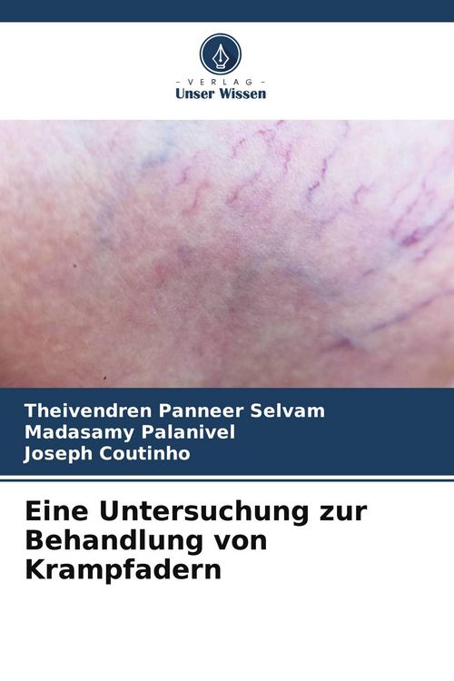 Produktbild: Eine Untersuchung zur Behandlung von Krampfadern