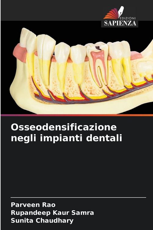 Produktbild: Osseodensificazione negli impianti dentali