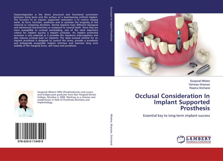 Produktbild: Occlusal Consideration In Implant Supported Prosthesis