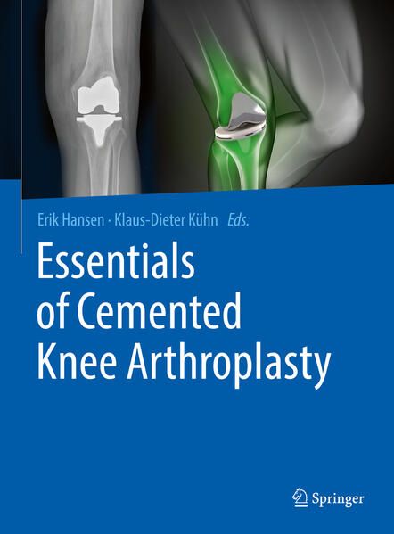 Produktbild: Essentials of Cemented Knee Arthroplasty