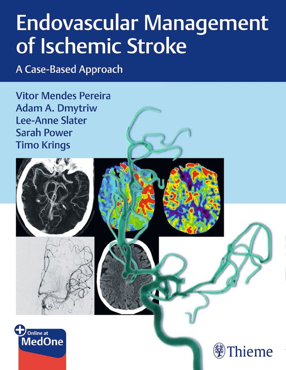 Produktbild: Endovascular Management of Ischemic Stroke