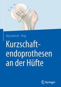 Produktbild: Kurzschaftendoprothesen an der H&uuml;fte