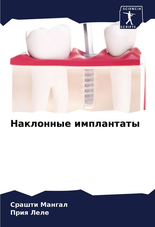 Produktbild: Naklonnye implantaty
