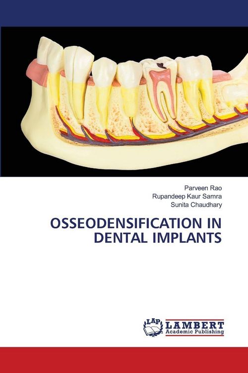 Produktbild: OSSEODENSIFICATION IN DENTAL IMPLANTS