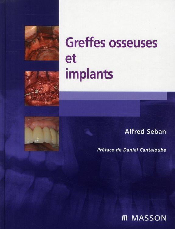 Produktbild: Greffes osseuses et implants