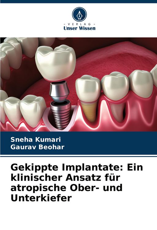 Produktbild: Gekippte Implantate: Ein klinischer Ansatz f&uuml;r atropische Ober- und Unterkiefer