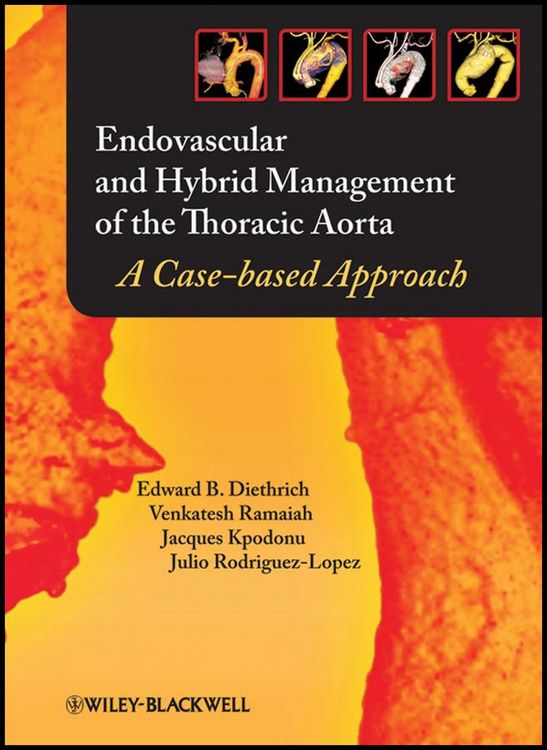 Produktbild: Endovascular and Hybrid Management of the Thoracic Aorta