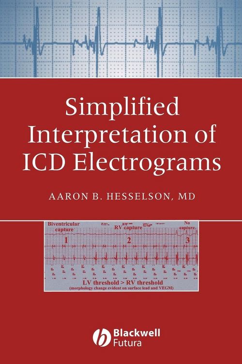 Produktbild: Simplified Interpretation of ICD Electrograms