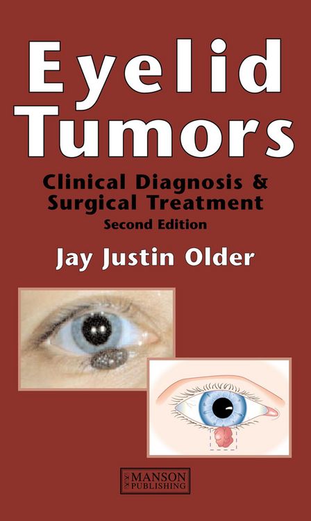 Produktbild: Eyelid Tumors