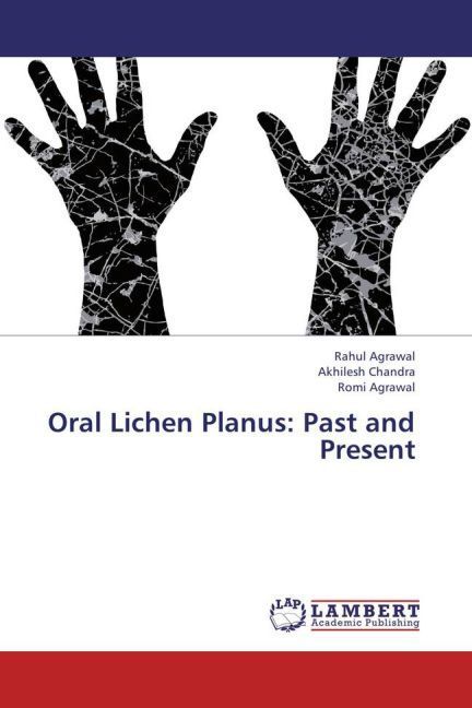 Produktbild: Agrawal, R: Oral Lichen Planus: Past and Present