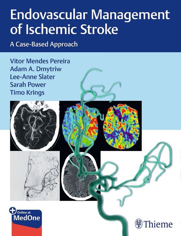 Produktbild: Endovascular Management of Ischemic Stroke