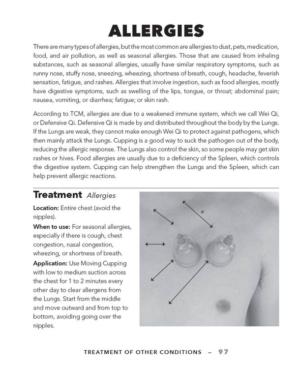 Produktbild: Cupping Therapy for Muscles and Joints
