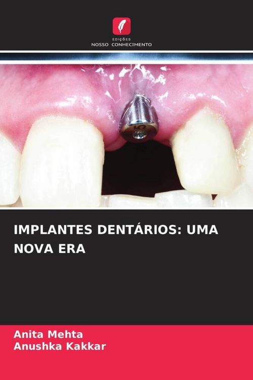 Produktbild: Implantes Dent&aacute;rios: Uma Nova Era