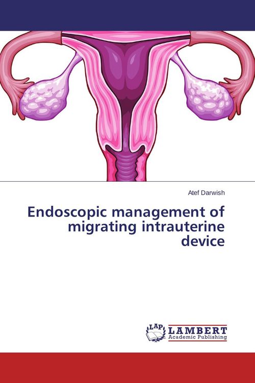Produktbild: Endoscopic management of migrating intrauterine device