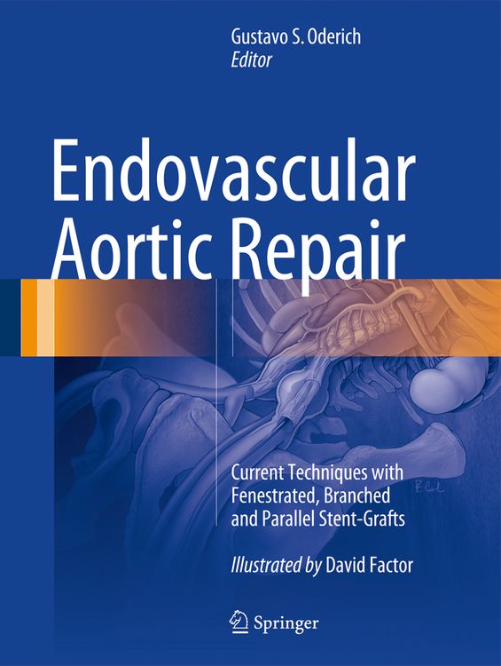 Produktbild: Endovascular Aortic Repair