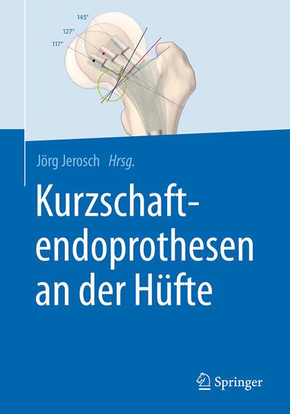 Produktbild: Kurzschaftendoprothesen an der H&uuml;fte
