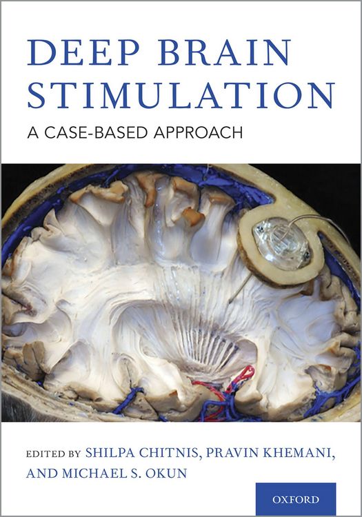 Produktbild: Deep Brain Stimulation