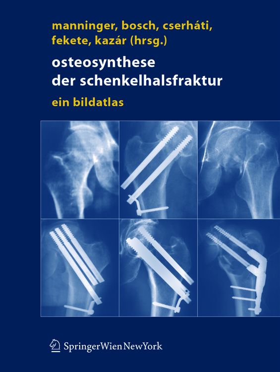 Produktbild: Osteosynthese der Schenkelhalsfraktur