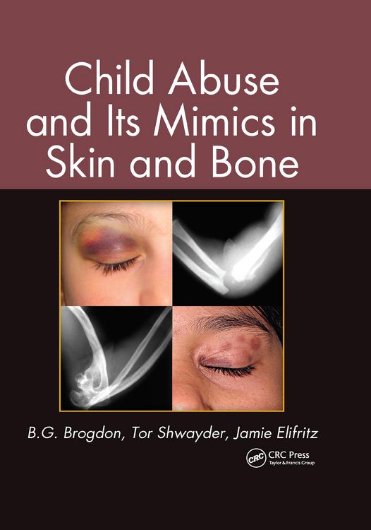 Produktbild: Child Abuse and its Mimics in Skin and Bone