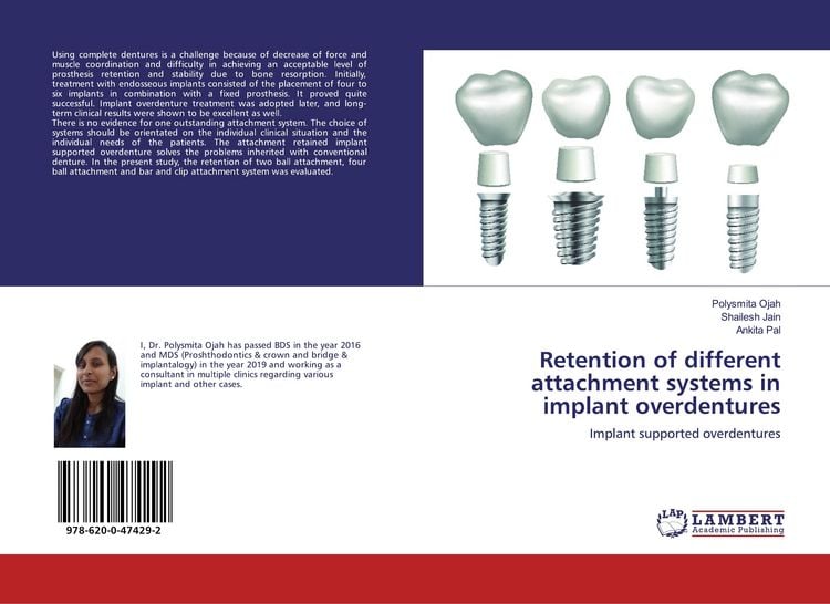 Produktbild: Retention of different attachment systems in implant overdentures
