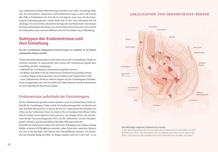 Produktbild: Endometriose &ndash; Die untersch&auml;tzte Krankheit