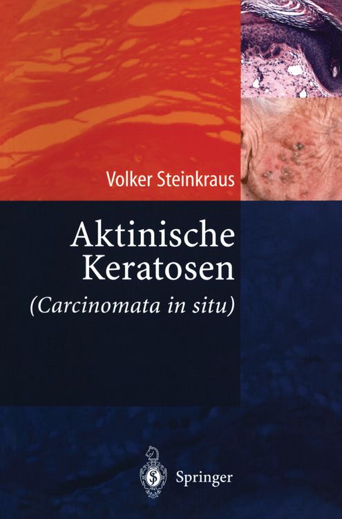 Produktbild: Aktinische Keratosen (Carcinomata in situ)