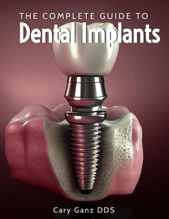 Produktbild: The Complete Guide to Dental Implants (All About Dentistry)