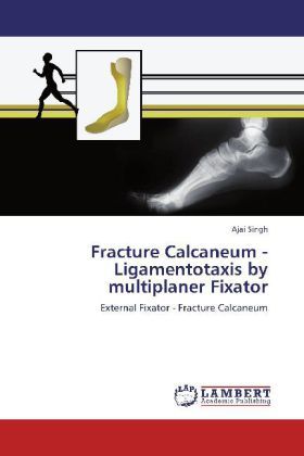 Produktbild: Singh, A: Fracture Calcaneum - Ligamentotaxis by multiplaner