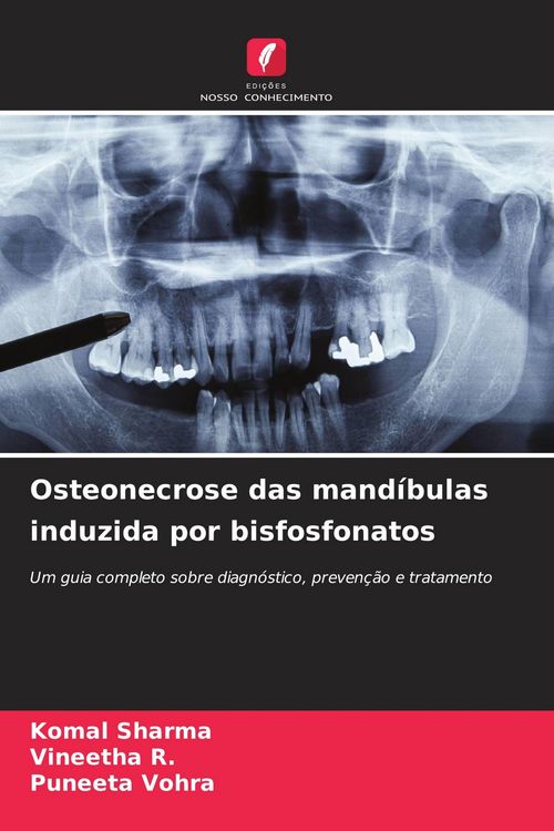 Produktbild: Osteonecrose das mand&iacute;bulas induzida por bisfosfonatos