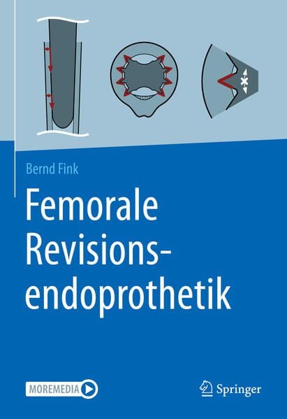 Produktbild: Femorale Revisionsendoprothetik