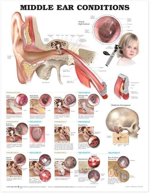 Produktbild: Middle Ear Conditions Anatomical Chart