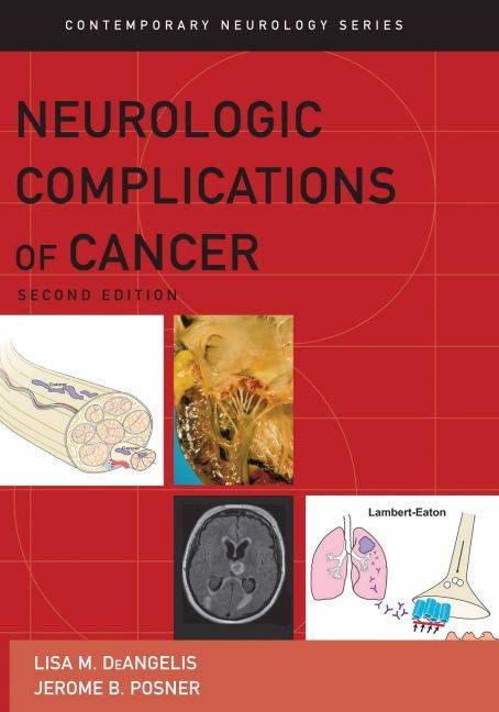 Produktbild: Neurologic Complications Of Ca