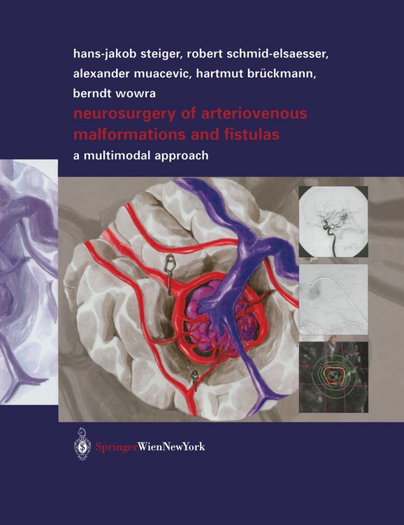 Produktbild: Neurosurgery of Arteriovenous Malformations and Fistulas
