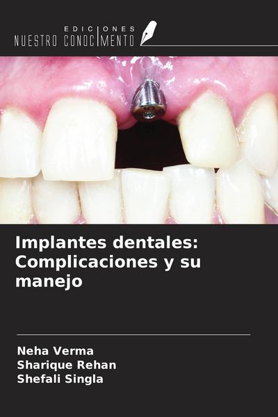 Produktbild: Implantes dentales: Complicaciones y su manejo