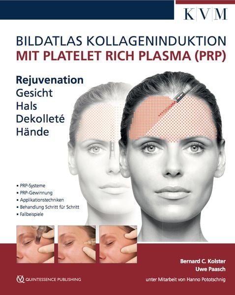 Bildatlas Kollageninduktion mit Platelet Rich Plasma (PRP), Gebundene Ausgabe von Uwe Paasch,Bernard C. Kolster, KVM - Der Medizinverlag,