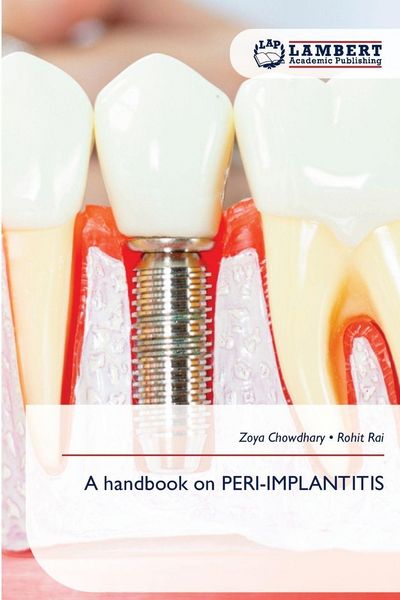 Produktbild: A Handbook On Peri-Implantitis
