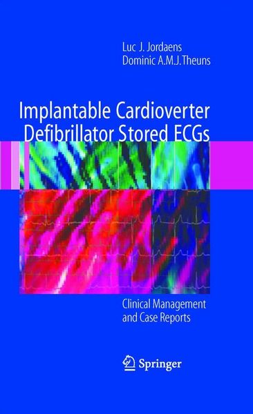 Produktbild: Implantable Cardioverter Defibrillator Stored ECGs