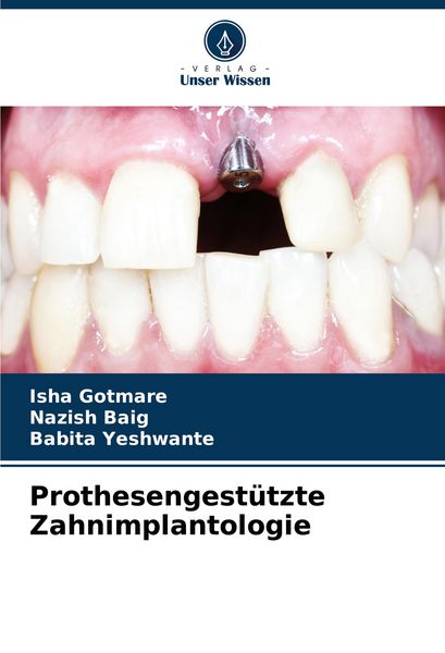 Produktbild: Prothesengest&uuml;tzte Zahnimplantologie