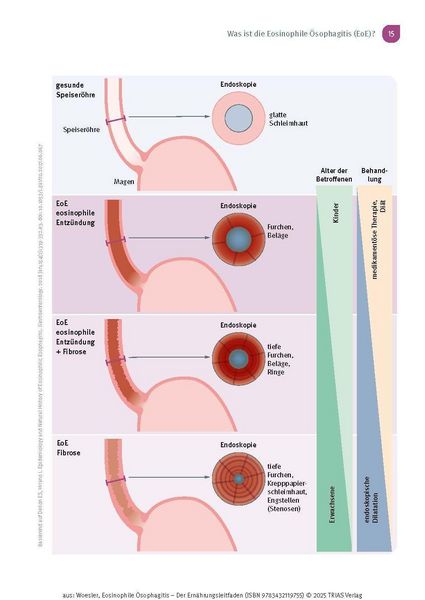 Produktbild: Eosinophile &Ouml;sophagitis - Der Ern&auml;hrungsleitfaden