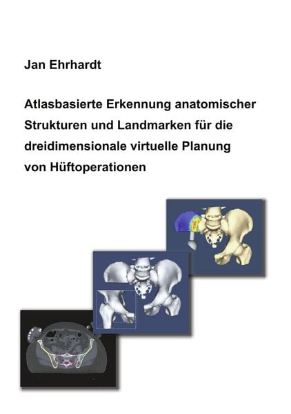 Produktbild: Atlasbasierte Erkennung anatomischer Strukturen und Landmarken für die dreidimensionale virtuelle Planung von Hüftoperationen